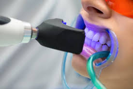 teeth whitening cost